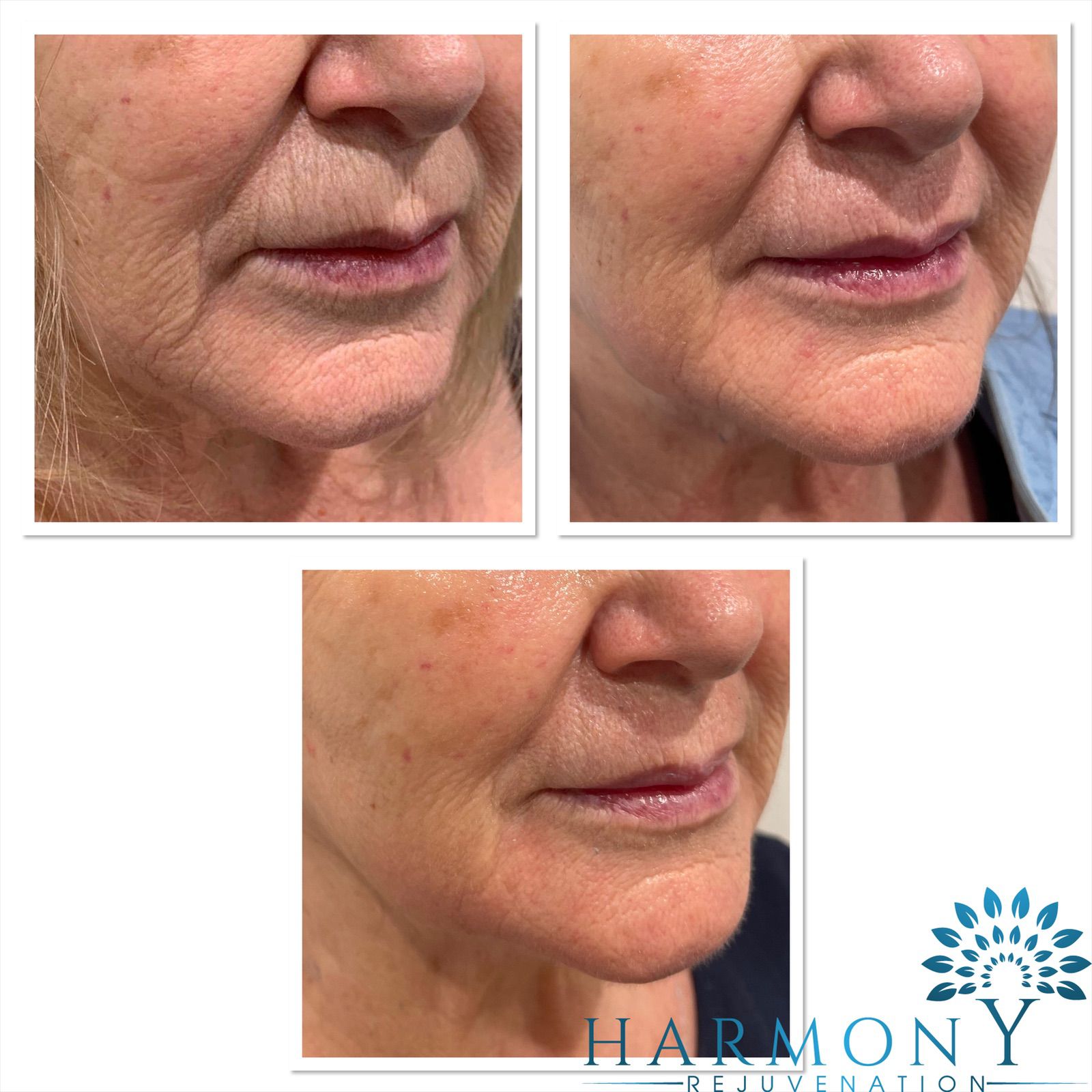 Bring Back Your Youth! Start your Dermalux Course today!