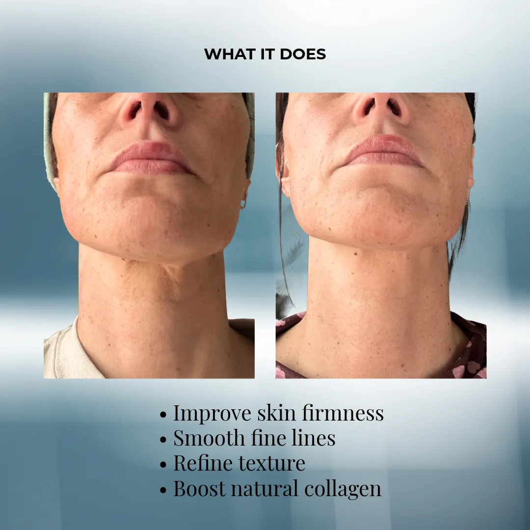 New Treatment Launch: Advanced Needle-Free Fractional Radiofrequency Skin Rejuvenation